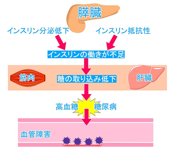 糖尿病のイメージ写真